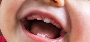 An up-close look at a baby’s primary teeth erupting through the gums